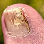 Fungal Nails